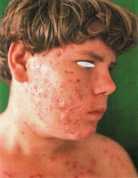 acne vulgaris.jpg